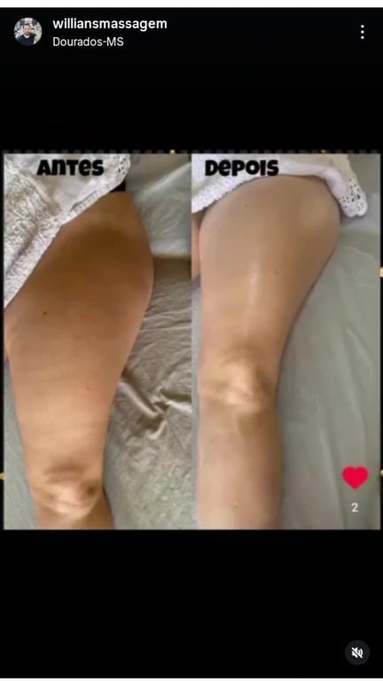 Massagem tântrica, orgasmo múltiplos , ventosaterapia ,Drenagem l Massagem